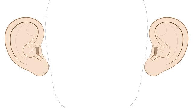 Kepçe kulak çocuğunuzun psikolojisini bozmasın