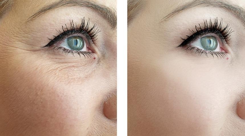 Estetik yaptırmadan evde kaz ayaklarınızı giderebilirsiniz! Yumurta akı, salatalık...