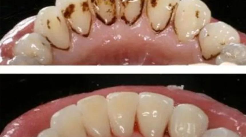  Diş taşlarına doğal y&ouml;ntemlerle elvada! Paranız cebinizde kalacak...