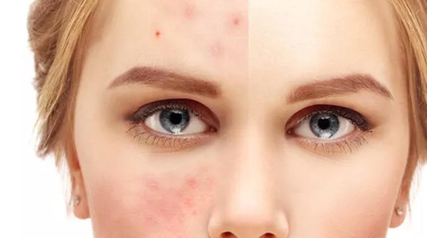 Y&uuml;z&uuml;n&uuml;zdeki ve sırtınızda oluşan sivilce lekeleri dert olmasın! Deniz tuzu, domates&hellip;