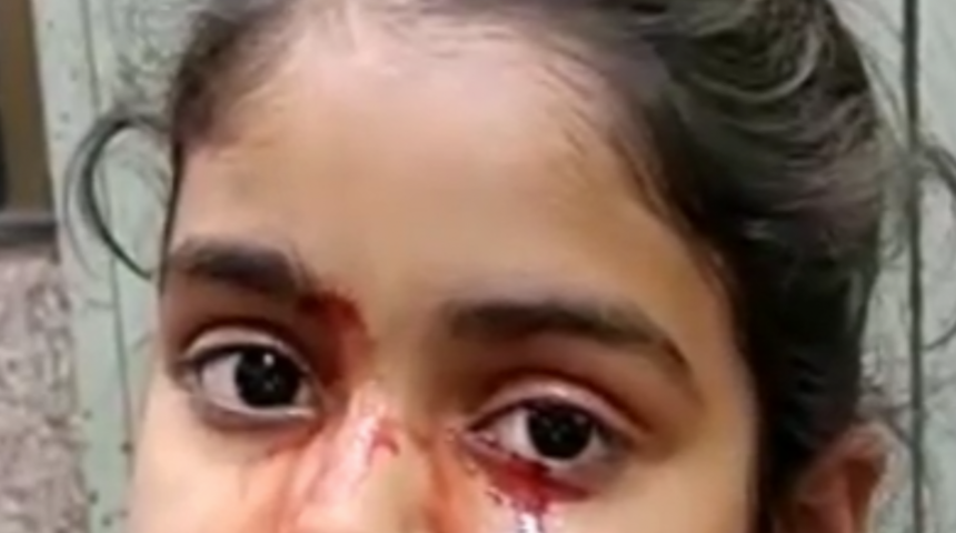 Nadir bir hastalık nedeniyle kan ağlıyor