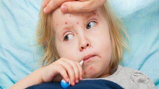 Kızamık: Nedenleri, belirtileri, tedavisi