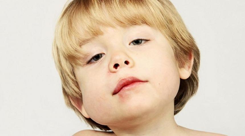 Kabakulak hastalığında artış