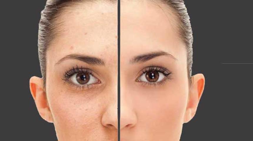 'Kimyasal Peeling' nedir?