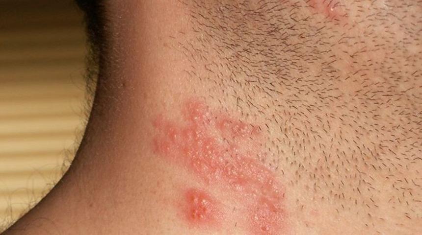 Zonanın asıl nedeni suçiçeği virüsü