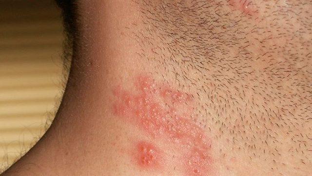 Zonanın asıl nedeni suçiçeği virüsü