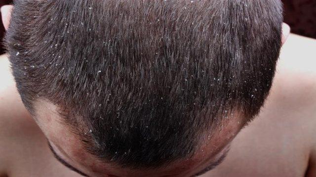 Saç egzamasına ne iyi gelir, evde tedavi ile nasıl geçer? Saç egzaması neden olur?