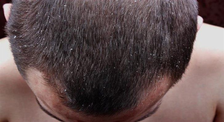 Saç egzamasına ne iyi gelir, evde tedavi ile nasıl geçer? Saç egzaması neden olur?