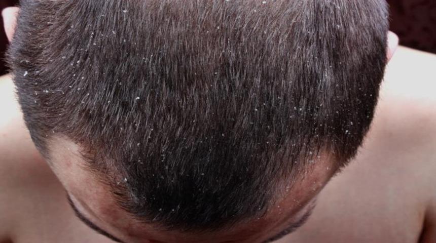 Sa&ccedil; egzamasına ne iyi gelir, evde tedavi ile nasıl ge&ccedil;er? Sa&ccedil; egzaması neden olur?