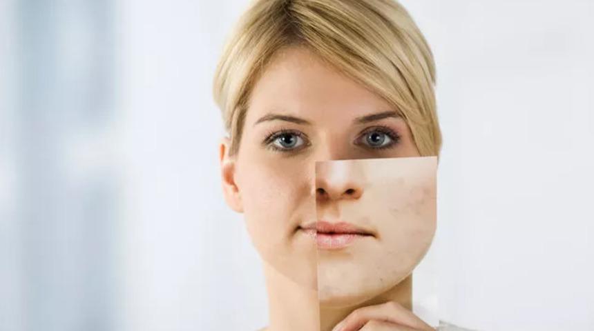 40 yaş sonrası cilt problemlerine dikkat! 