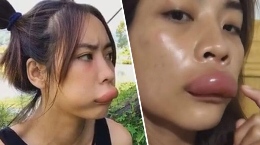 Yüzünü arı sokan kadının üst dudağı sosis gibi şişti