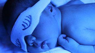 Yeni doğan bebeklerde sarılık rehberi