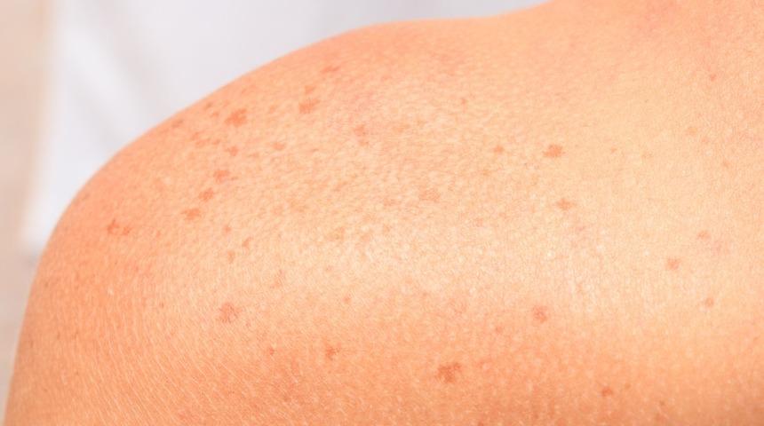 Bu y&ouml;ntemler g&uuml;neş lekelerinden geriye eser bırakmıyor! Doğal y&ouml;ntemler i&ccedil;in...