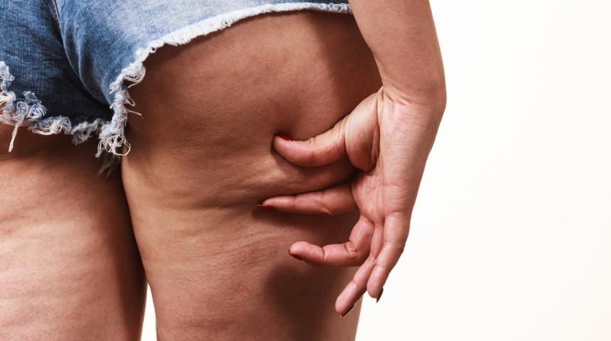 Sel&uuml;litlerden kurtulmak i&ccedil;in pahalı kremlere ihtiyacınız yok! Tek yapmanız gereken...