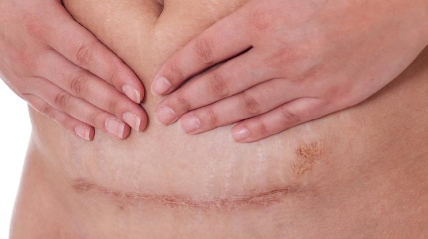 Gerçekten korkmalı mıyız? Tüm yönleri ile sezaryen doğum