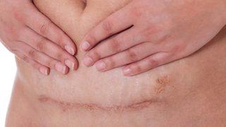 Gerçekten korkmalı mıyız? Tüm yönleri ile sezaryen doğum