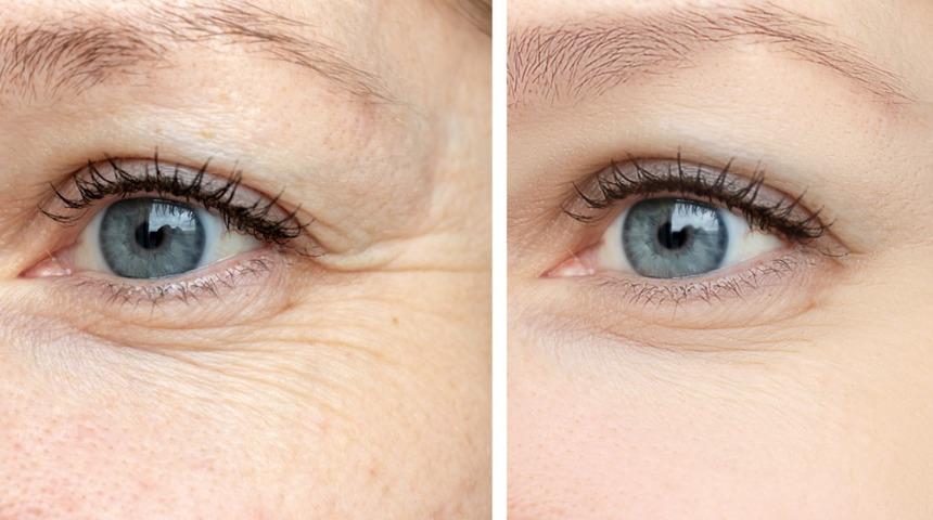 Bu maske tarifleri kırışıklık ve kaz ayaklarını yok ediyor! Yumurta beyazı, muz...