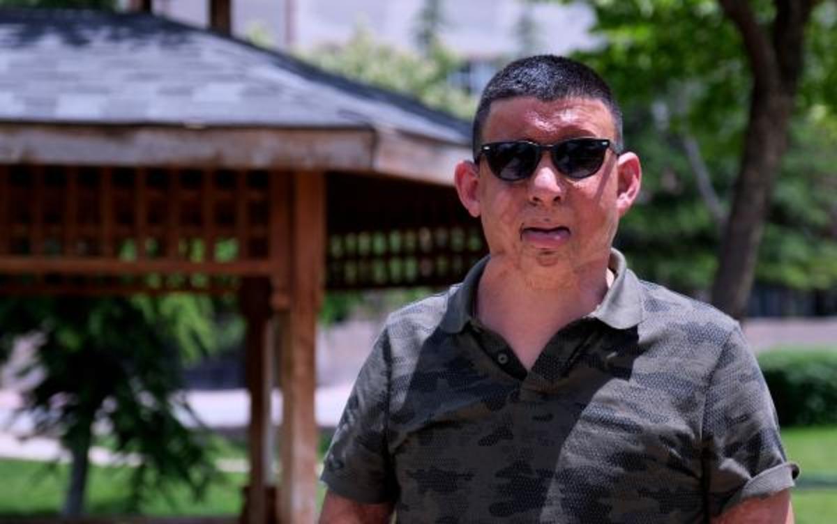 Akıma kapılıp v&uuml;cudunun b&uuml;y&uuml;k bir b&ouml;l&uuml;m&uuml; yanmıştı! Cumhurbaşkanı'nın talimatıyla hayatı değişti