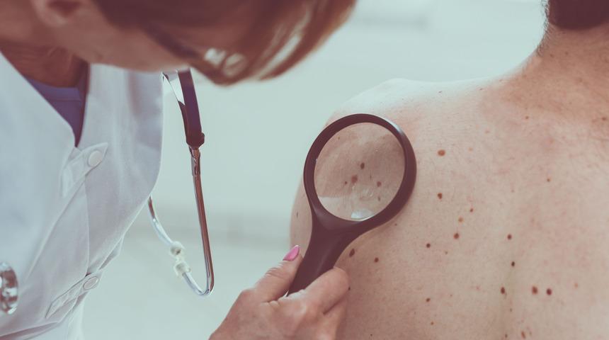 Cilt Kanseri: Nedenleri, belirtileri, tedavisi