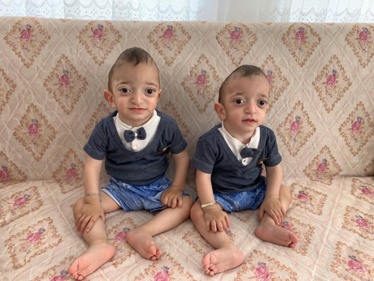 Hasta ikiz &ccedil;ocuklar yardım bekliyor