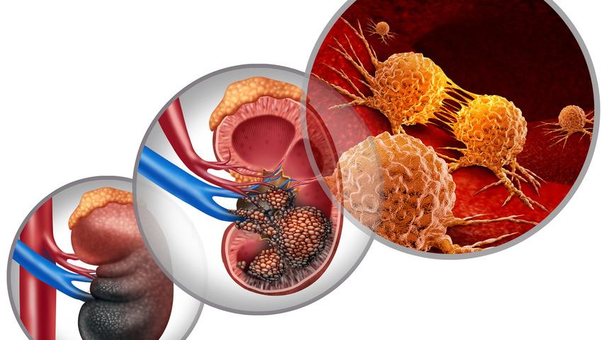 Böbrek kanseri belirti vermiyor ama... En etkili tedavi cerrahi!