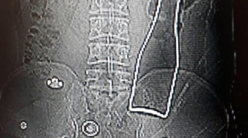 Vücudundan şişe çıkan genç konuştu! 'Yanlışlıkla oldu'
