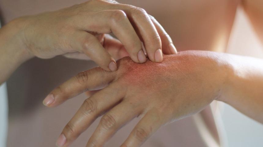 Yıpranmış ve kurumuş eller i&ccedil;in mezoterapi