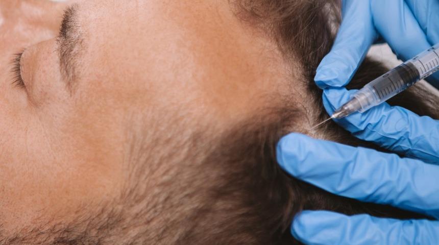 Sa&ccedil; ekiminde PRP uygulaması