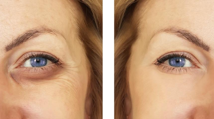 Estetik operasyonlara para saçmaya gerek kalmadı! Göz altı morluklarından kurtulmak için...