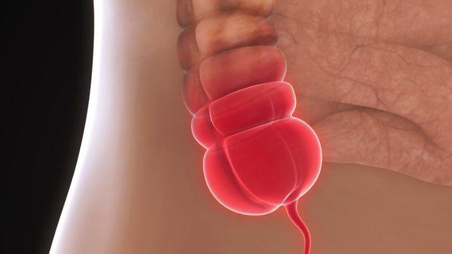 Apandisit: Nedenleri, belirtileri, tedavisi