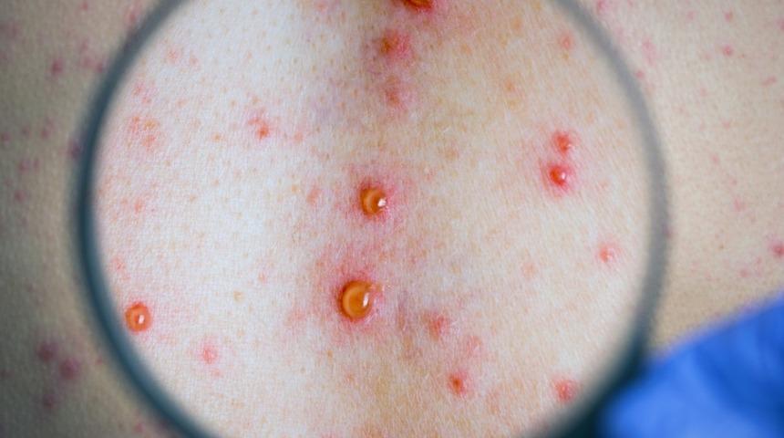 Frengi : Nedenleri, belirtileri, tedavisi