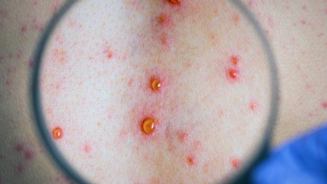 Frengi : Nedenleri, belirtileri, tedavisi