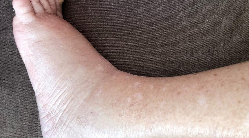 Fil hastalığı : Nedenleri, belirtileri, tedavisi