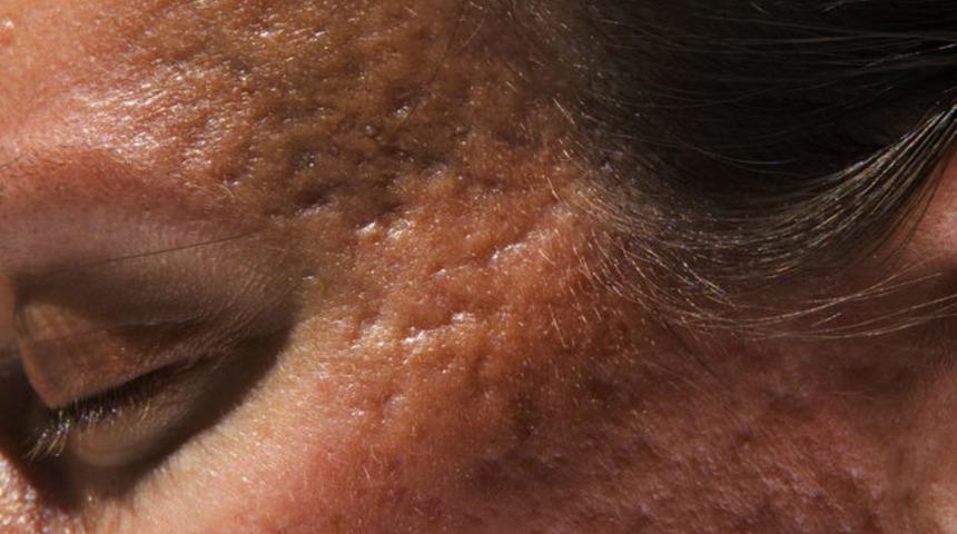 Sivilceden geriye kalan izler nasıl geçer?