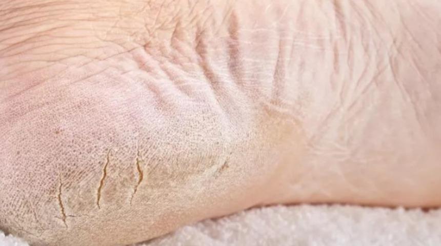 Bu y&ouml;ntemler ile topuk &ccedil;atlaklarına meydan okuyun! Pirin&ccedil; unu, bal&hellip;