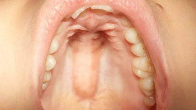 Dilinizi damağınıza değdirin... 10 kişiden yalnızca 2 kişide var... Sizde de olabilir!