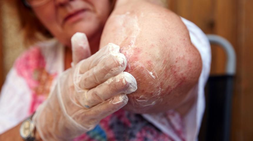 Egzama: Nedenleri, belirtileri, tedavisi