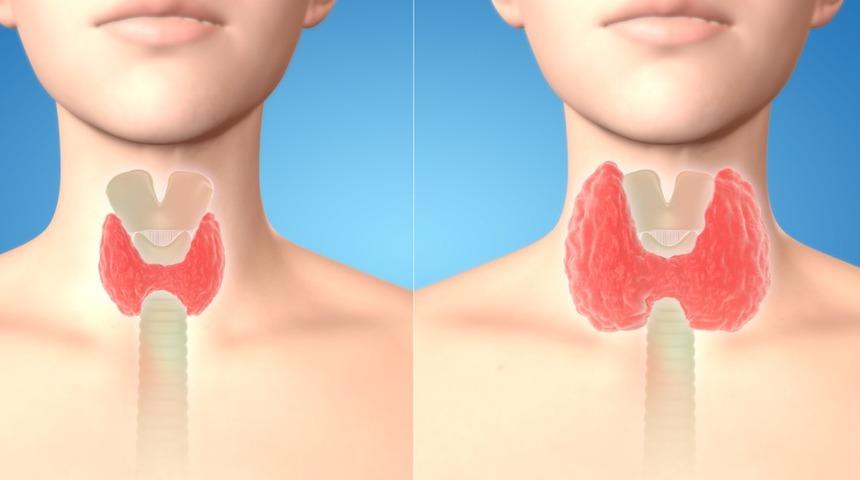 Guatr : Nedenleri, belirtileri, tedavisi