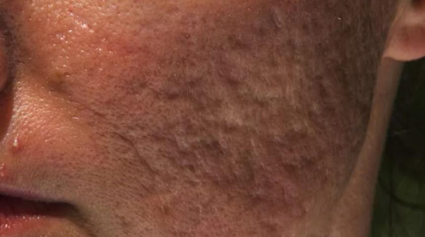 Sivilceden geriye kalan izler nasıl geçer?