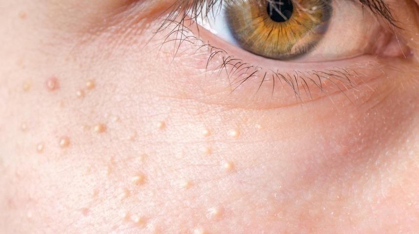 Bu doğal tarifler yüzdeki küçük bezeleri yok ediyor! Rezene, patates, bal...