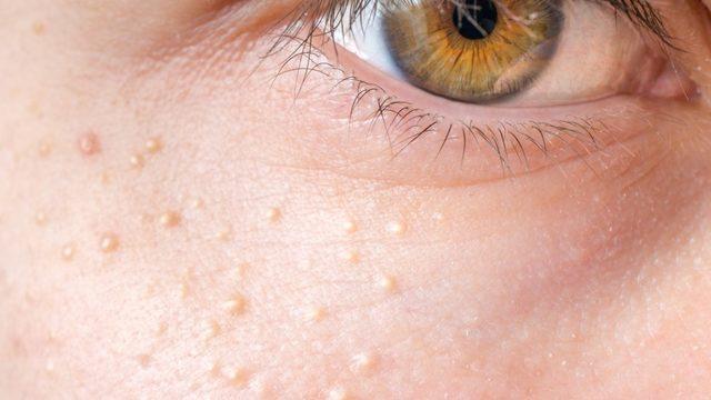 Bu doğal tarifler yüzdeki küçük bezeleri yok ediyor! Rezene, patates, bal...