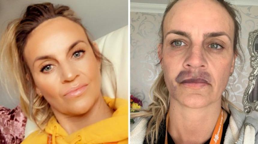 Karantinada evde yapılan dudak dolgusu korkun&ccedil; şekilde sonu&ccedil;landı