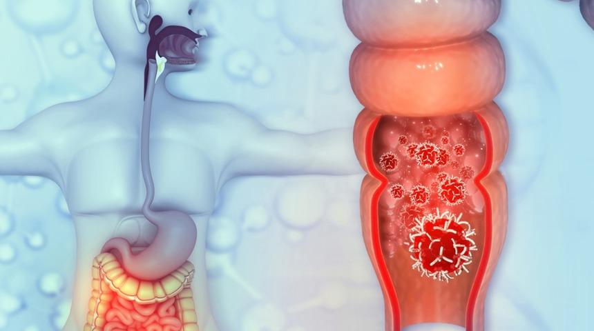 Rektum kanseri : Nedenleri, belirtileri, tedavisi