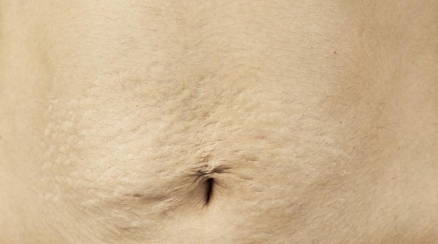  Gebelik sonrası sarkmalara dikkat! İşte &ccedil;&ouml;z&uuml;m&uuml;