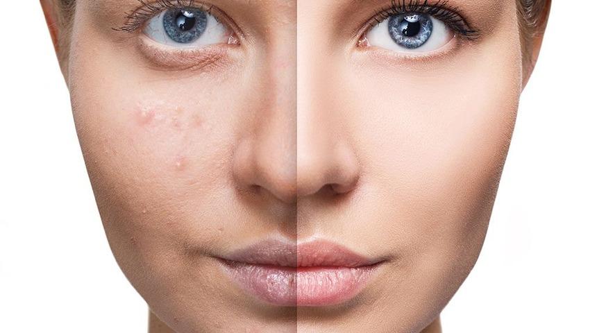 Dermapen Hakkında Bilmeniz Gerekenler