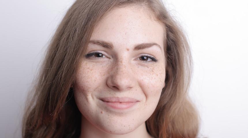 Bu doğal y&ouml;ntemler g&uuml;neş lekelerini yok ediyor! Patates, yeşil &ccedil;ay, s&uuml;t...