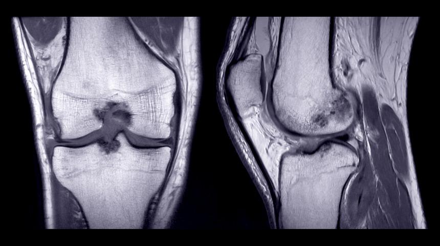 Uzun süreli koşanlarda kıkırdak hasarı daha fazla mı yaşanıyor?