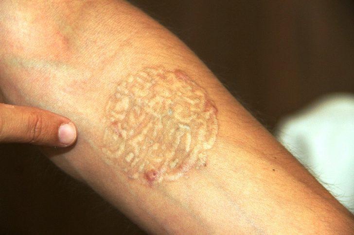 Dövmelerini sildirmek istedi! Hayatı kabusa dönüştü G1