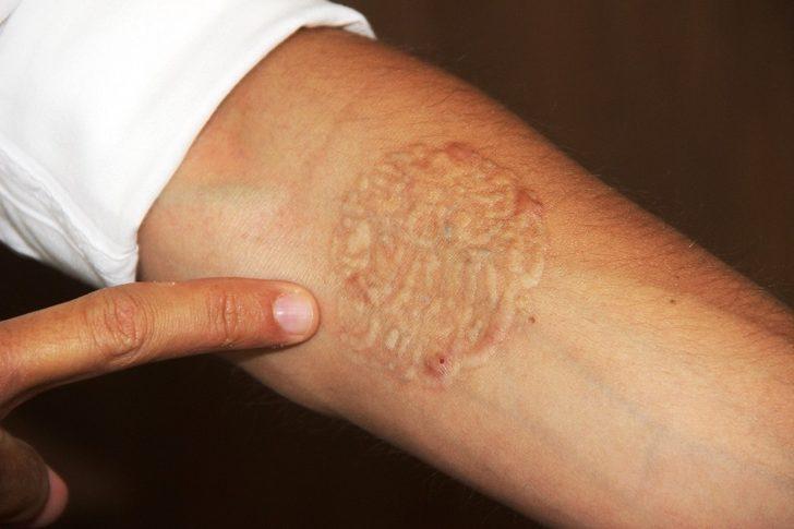 Dövmelerini sildirmek istedi! Hayatı kabusa dönüştü G4