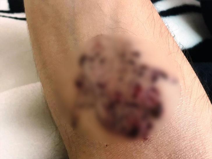 Dövmelerini sildirmek istedi! Hayatı kabusa dönüştü G5